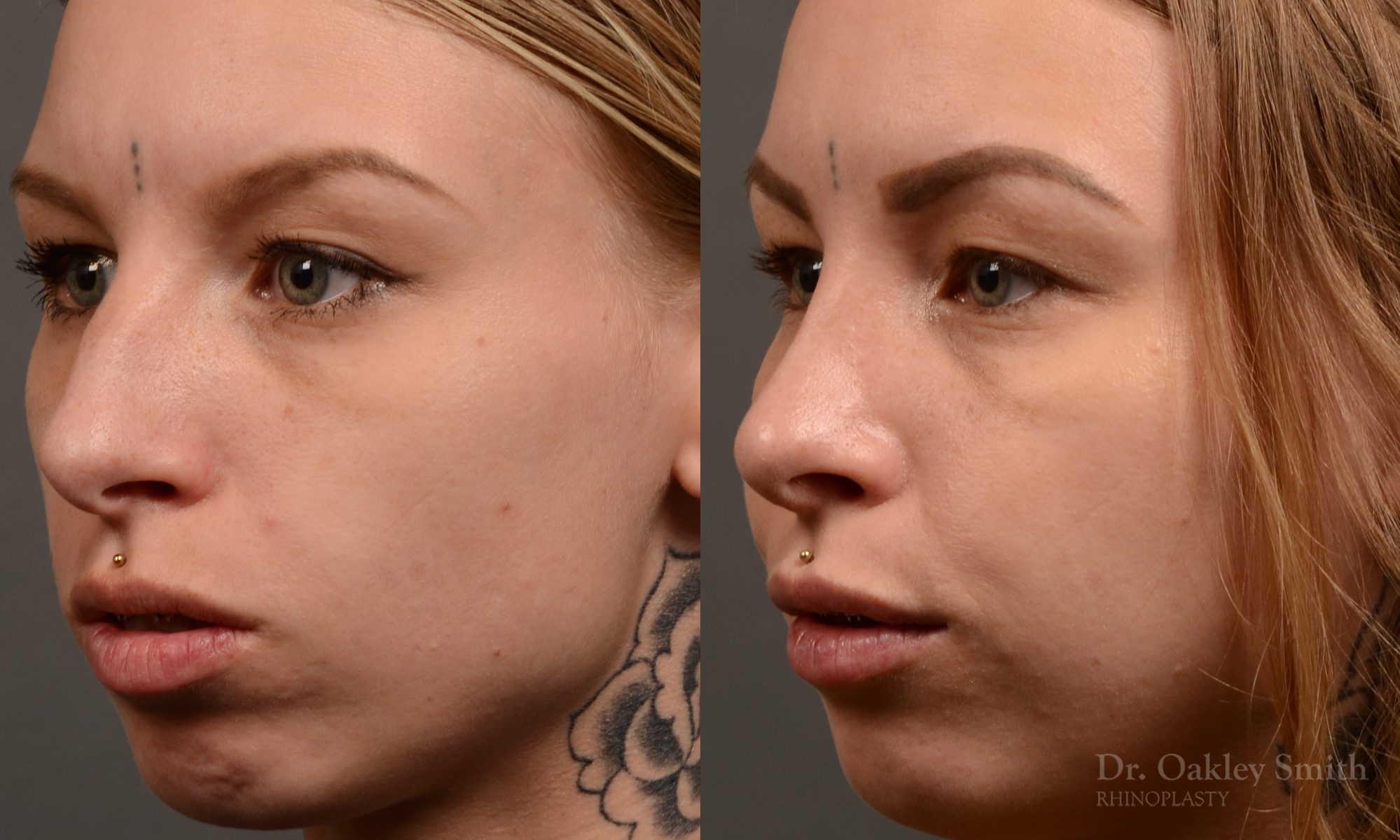 left third view rhinoplasty nose job