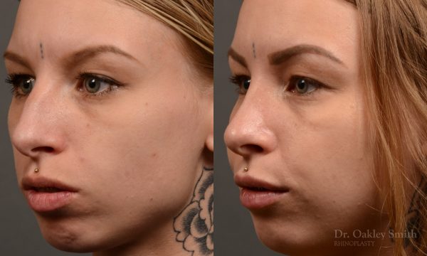 left third view rhinoplasty nose job