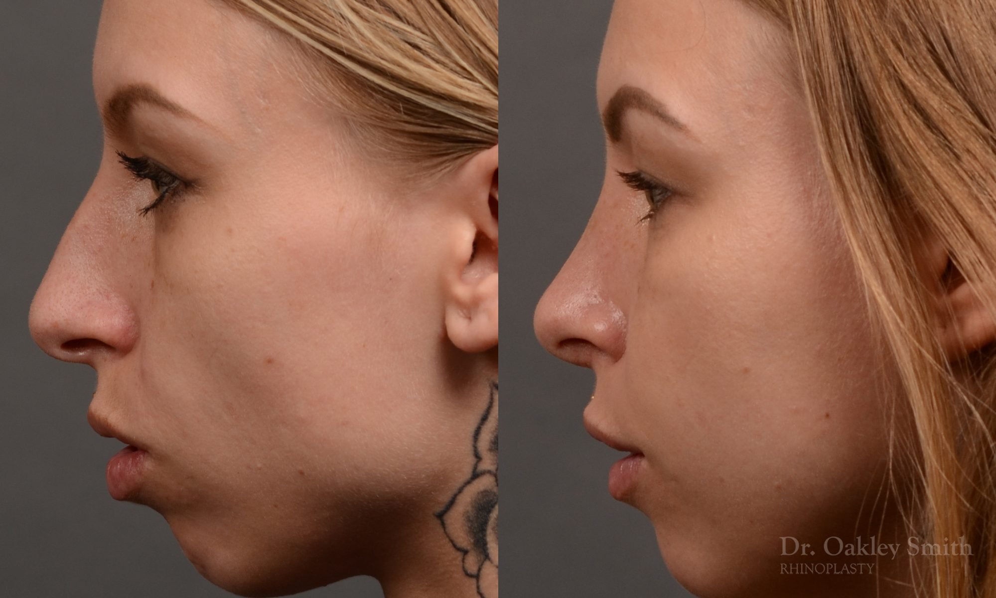 left profile side view rhinoplasty nose job