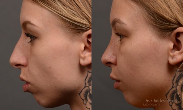 Nothing demonstrates the skillful craftsmanship that Dr. Oakley Smith accomplishes during his surgeries than a collection of before and after case studies. As one of a hand full of surgeons in North America who limits his practice to only Rhinoplasty surgery, it is obvious that he has mastered his art. There is no question why he is one of the busiest cosmetic nose job surgeons in the country.