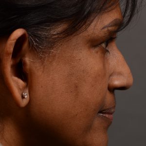 Nothing demonstrates the skillful craftsmanship that Dr. Oakley Smith accomplishes during his surgeries than a collection of before and after case studies. As one of a hand full of surgeons in North America who limits his practice to only Rhinoplasty surgery, it is obvious that he has mastered his art. There is no question why he is one of the busiest cosmetic nose job surgeons in the country.