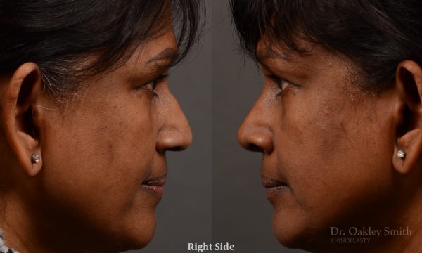 Nothing demonstrates the skillful craftsmanship that Dr. Oakley Smith accomplishes during his surgeries than a collection of before and after case studies. As one of a hand full of surgeons in North America who limits his practice to only Rhinoplasty surgery, it is obvious that he has mastered his art. There is no question why he is one of the busiest cosmetic nose job surgeons in the country.