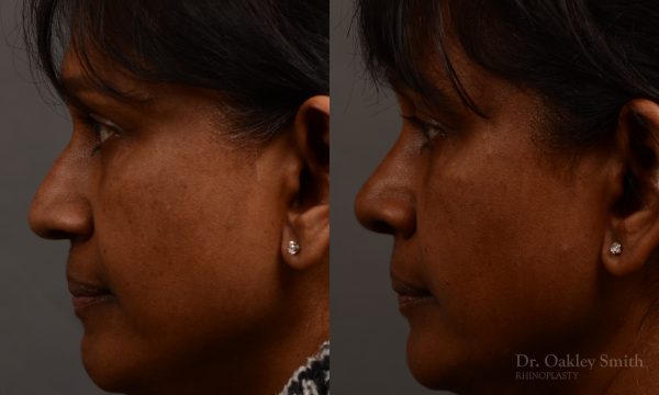 Nothing demonstrates the skillful craftsmanship that Dr. Oakley Smith accomplishes during his surgeries than a collection of before and after case studies. As one of a hand full of surgeons in North America who limits his practice to only Rhinoplasty surgery, it is obvious that he has mastered his art. There is no question why he is one of the busiest cosmetic nose job surgeons in the country.