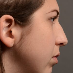 rhinplasty Nothing demonstrates the skillful craftsmanship that Dr. Oakley Smith accomplishes during his surgeries than a collection of before and after case studies. As one of a hand full of surgeons in North America who limits his practice to only Rhinoplasty surgery, it is obvious that he has mastered his art. There is no question why he is one of the busiest cosmetic nose job surgeons in the country.