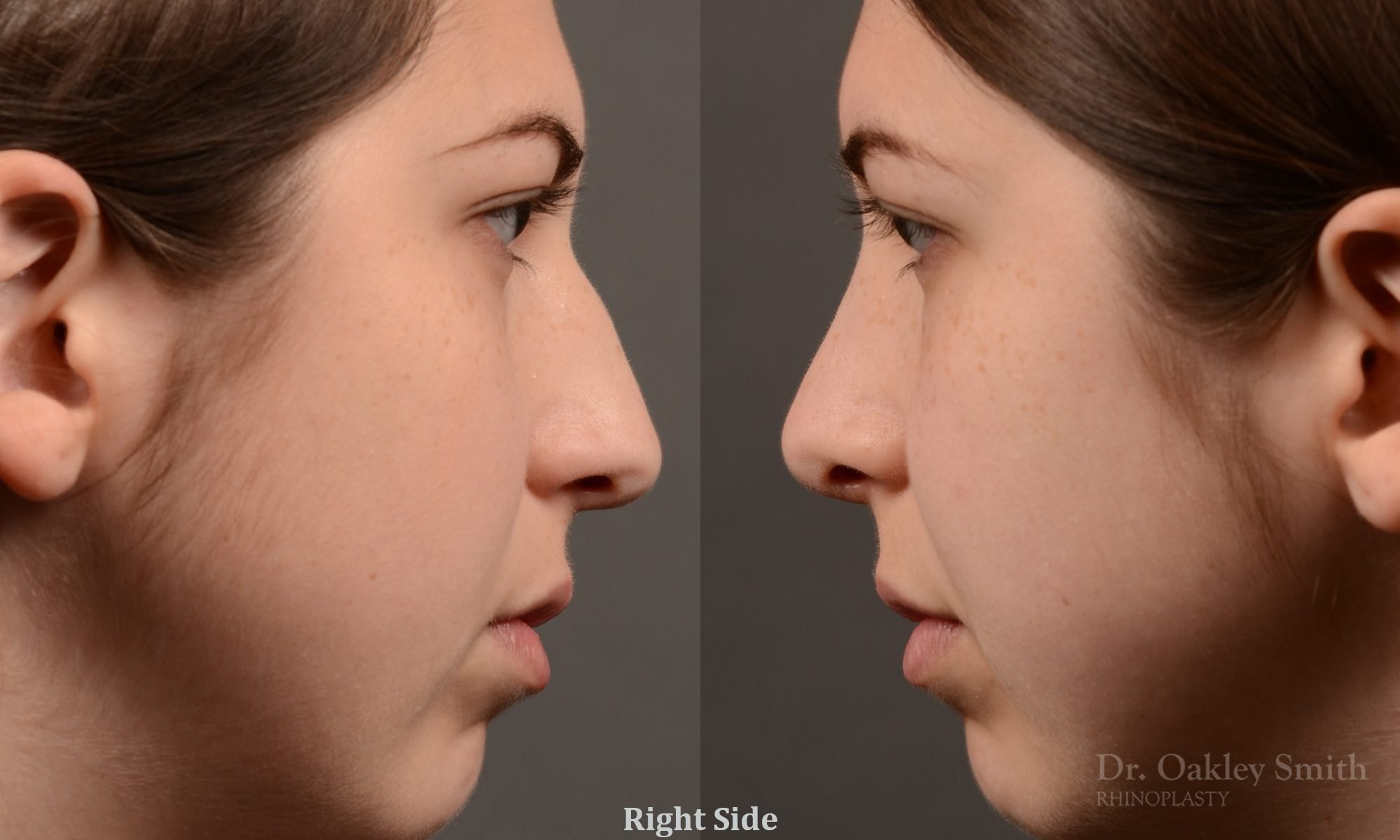 rhinoplasty Nothing demonstrates the skillful craftsmanship that Dr. Oakley Smith accomplishes during his surgeries than a collection of before and after case studies. As one of a hand full of surgeons in North America who limits his practice to only Rhinoplasty surgery, it is obvious that he has mastered his art. There is no question why he is one of the busiest cosmetic nose job surgeons in the country.