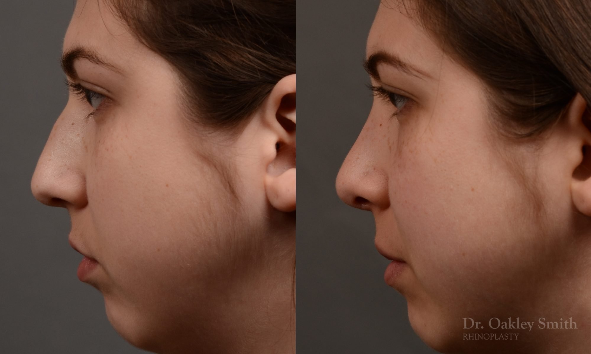 rhinoplasty Nothing demonstrates the skillful craftsmanship that Dr. Oakley Smith accomplishes during his surgeries than a collection of before and after case studies. As one of a hand full of surgeons in North America who limits his practice to only Rhinoplasty surgery, it is obvious that he has mastered his art. There is no question why he is one of the busiest cosmetic nose job surgeons in the country.