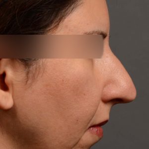 rhinoplasty Nothing demonstrates the skillful craftsmanship that Dr. Oakley Smith accomplishes during his surgeries than a collection of before and after case studies. As one of a hand full of surgeons in North America who limits his practice to only Rhinoplasty surgery, it is obvious that he has mastered his art. There is no question why he is one of the busiest cosmetic nose job surgeons in the country.