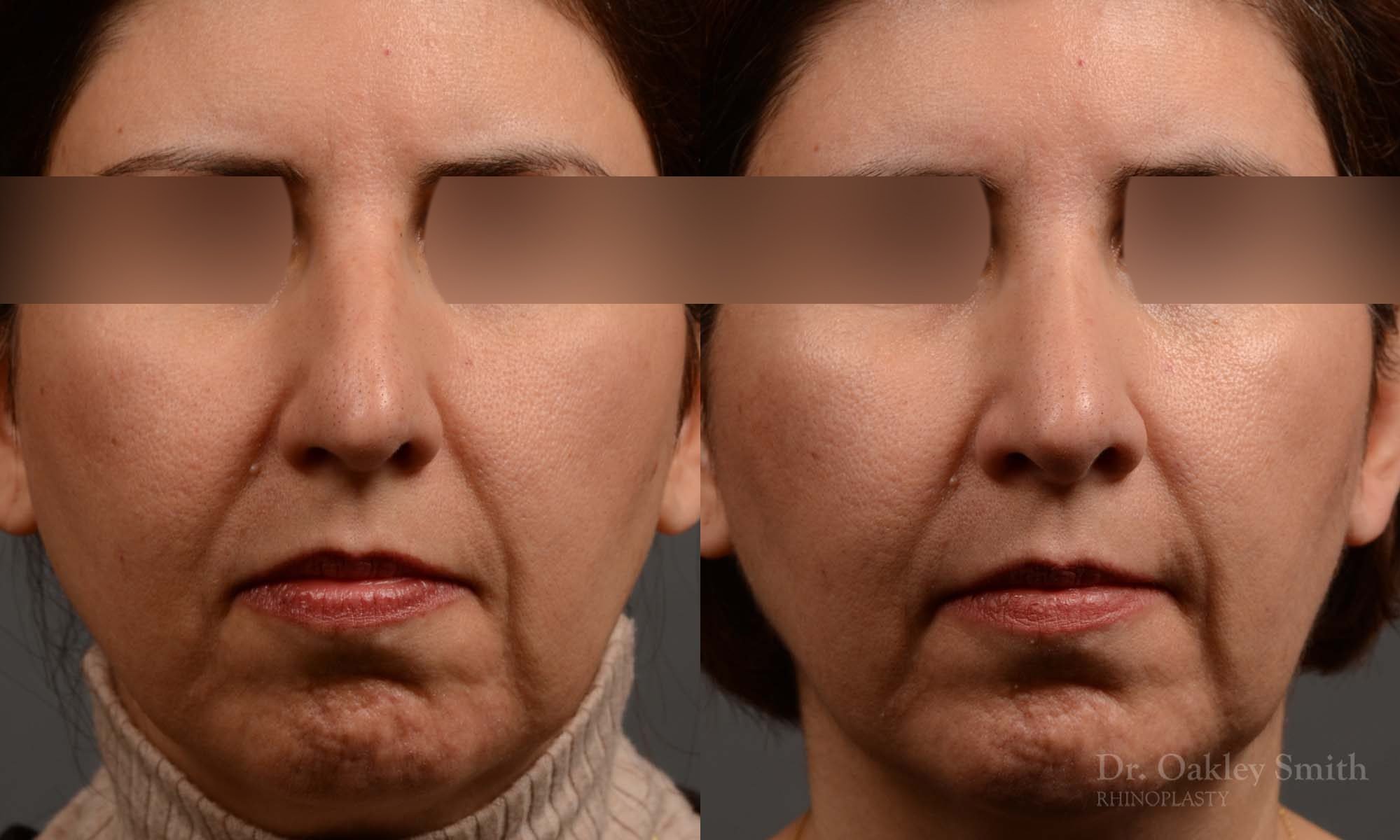 rhinoplasty Nothing demonstrates the skillful craftsmanship that Dr. Oakley Smith accomplishes during his surgeries than a collection of before and after case studies. As one of a hand full of surgeons in North America who limits his practice to only Rhinoplasty surgery, it is obvious that he has mastered his art. There is no question why he is one of the busiest cosmetic nose job surgeons in the country.