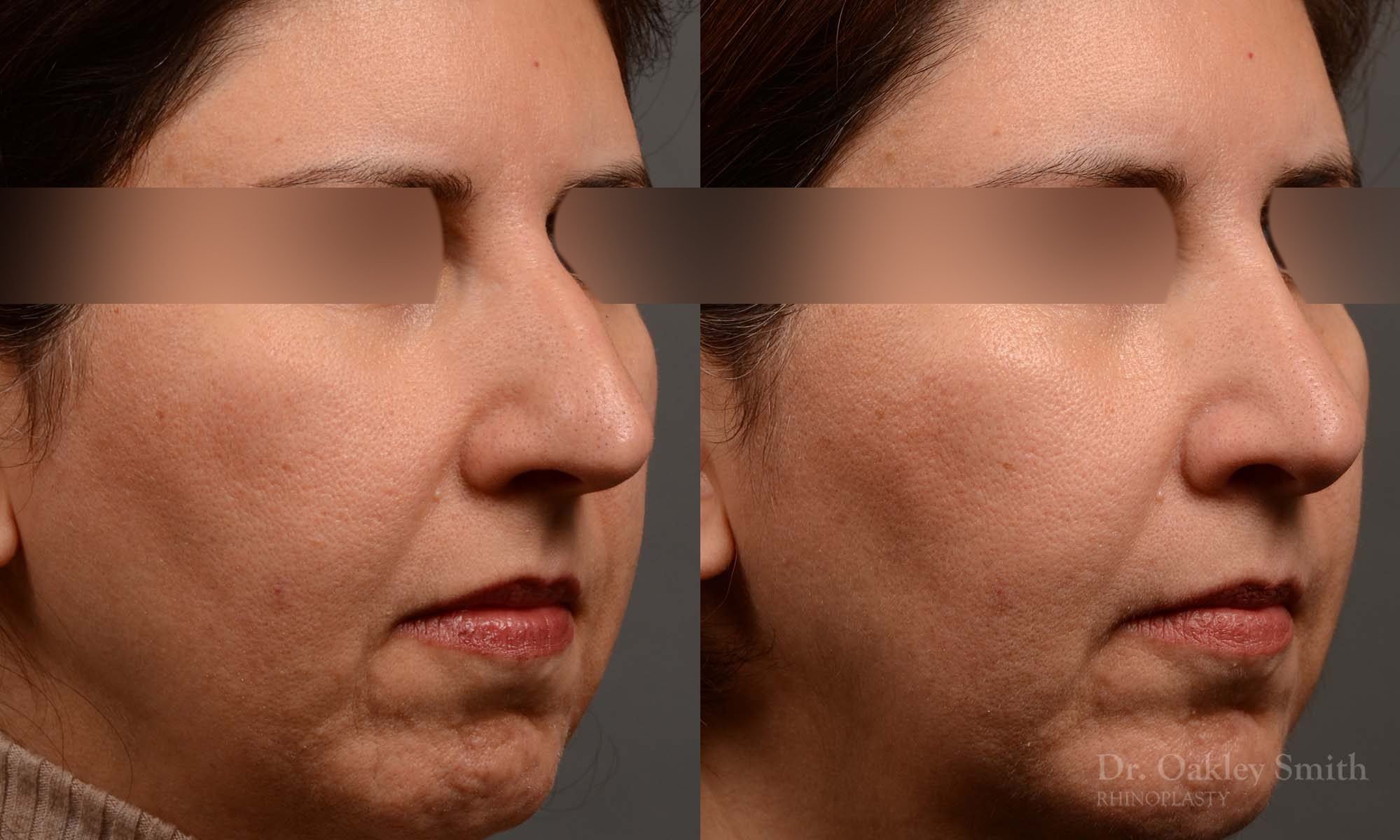 Hump Reduction, Rhinoplasty - Rhinoplasty Before and After Case 372