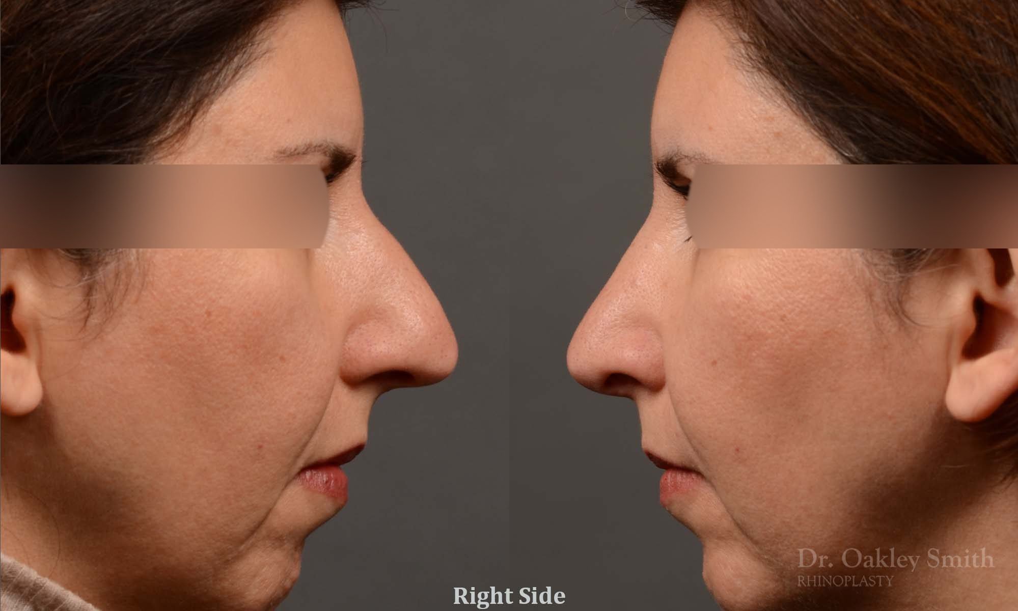 rhinoplasty Nothing demonstrates the skillful craftsmanship that Dr. Oakley Smith accomplishes during his surgeries than a collection of before and after case studies. As one of a hand full of surgeons in North America who limits his practice to only Rhinoplasty surgery, it is obvious that he has mastered his art. There is no question why he is one of the busiest cosmetic nose job surgeons in the country.