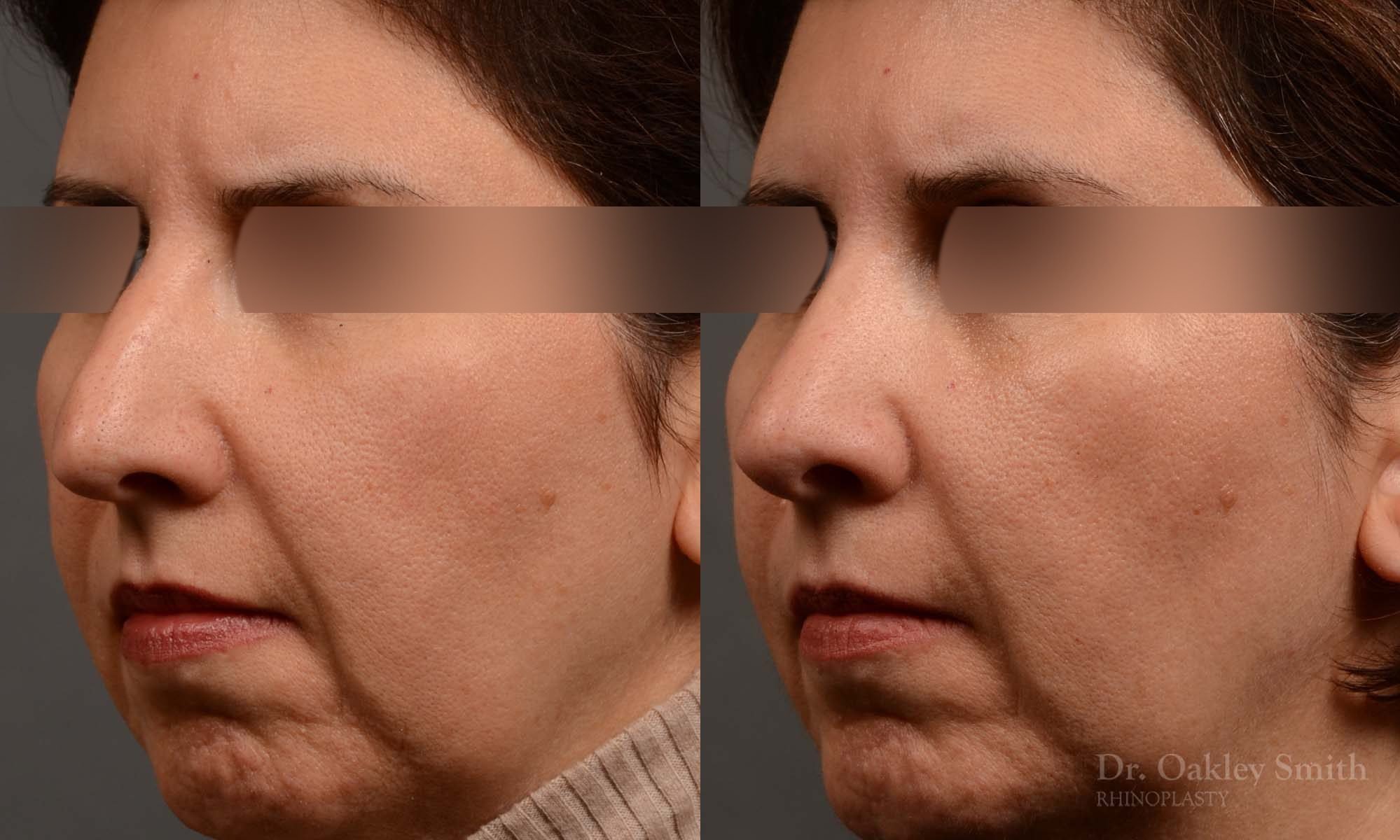 rhinoplasty Nothing demonstrates the skillful craftsmanship that Dr. Oakley Smith accomplishes during his surgeries than a collection of before and after case studies. As one of a hand full of surgeons in North America who limits his practice to only Rhinoplasty surgery, it is obvious that he has mastered his art. There is no question why he is one of the busiest cosmetic nose job surgeons in the country.