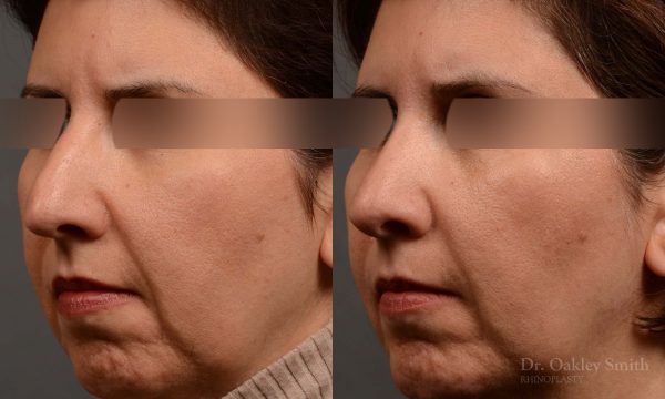 rhinoplasty Nothing demonstrates the skillful craftsmanship that Dr. Oakley Smith accomplishes during his surgeries than a collection of before and after case studies. As one of a hand full of surgeons in North America who limits his practice to only Rhinoplasty surgery, it is obvious that he has mastered his art. There is no question why he is one of the busiest cosmetic nose job surgeons in the country.