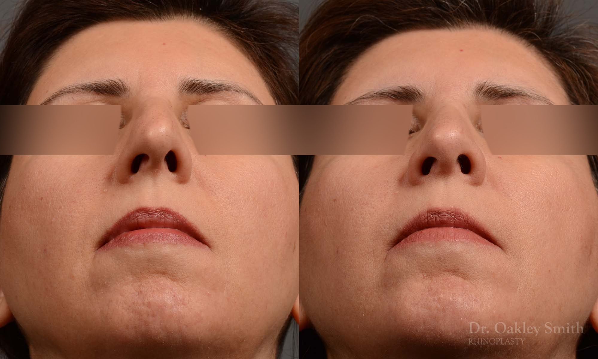 rhinoplasty Nothing demonstrates the skillful craftsmanship that Dr. Oakley Smith accomplishes during his surgeries than a collection of before and after case studies. As one of a hand full of surgeons in North America who limits his practice to only Rhinoplasty surgery, it is obvious that he has mastered his art. There is no question why he is one of the busiest cosmetic nose job surgeons in the country.