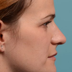 rhinoplasty Nothing demonstrates the skillful craftsmanship that Dr. Oakley Smith accomplishes during his surgeries than a collection of before and after case studies. As one of a hand full of surgeons in North America who limits his practice to only Rhinoplasty surgery, it is obvious that he has mastered his art. There is no question why he is one of the busiest cosmetic nose job surgeons in the country.