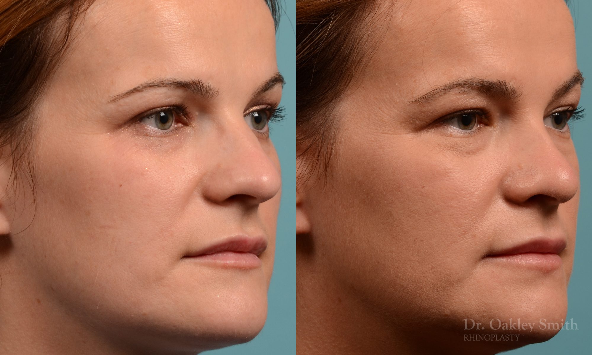 rhinoplasty Nothing demonstrates the skillful craftsmanship that Dr. Oakley Smith accomplishes during his surgeries than a collection of before and after case studies. As one of a hand full of surgeons in North America who limits his practice to only Rhinoplasty surgery, it is obvious that he has mastered his art. There is no question why he is one of the busiest cosmetic nose job surgeons in the country.