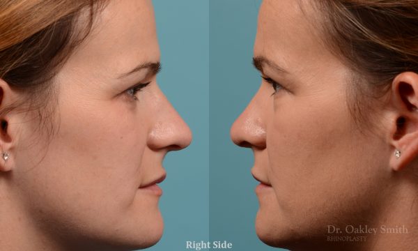 rhinoplasty Nothing demonstrates the skillful craftsmanship that Dr. Oakley Smith accomplishes during his surgeries than a collection of before and after case studies. As one of a hand full of surgeons in North America who limits his practice to only Rhinoplasty surgery, it is obvious that he has mastered his art. There is no question why he is one of the busiest cosmetic nose job surgeons in the country.