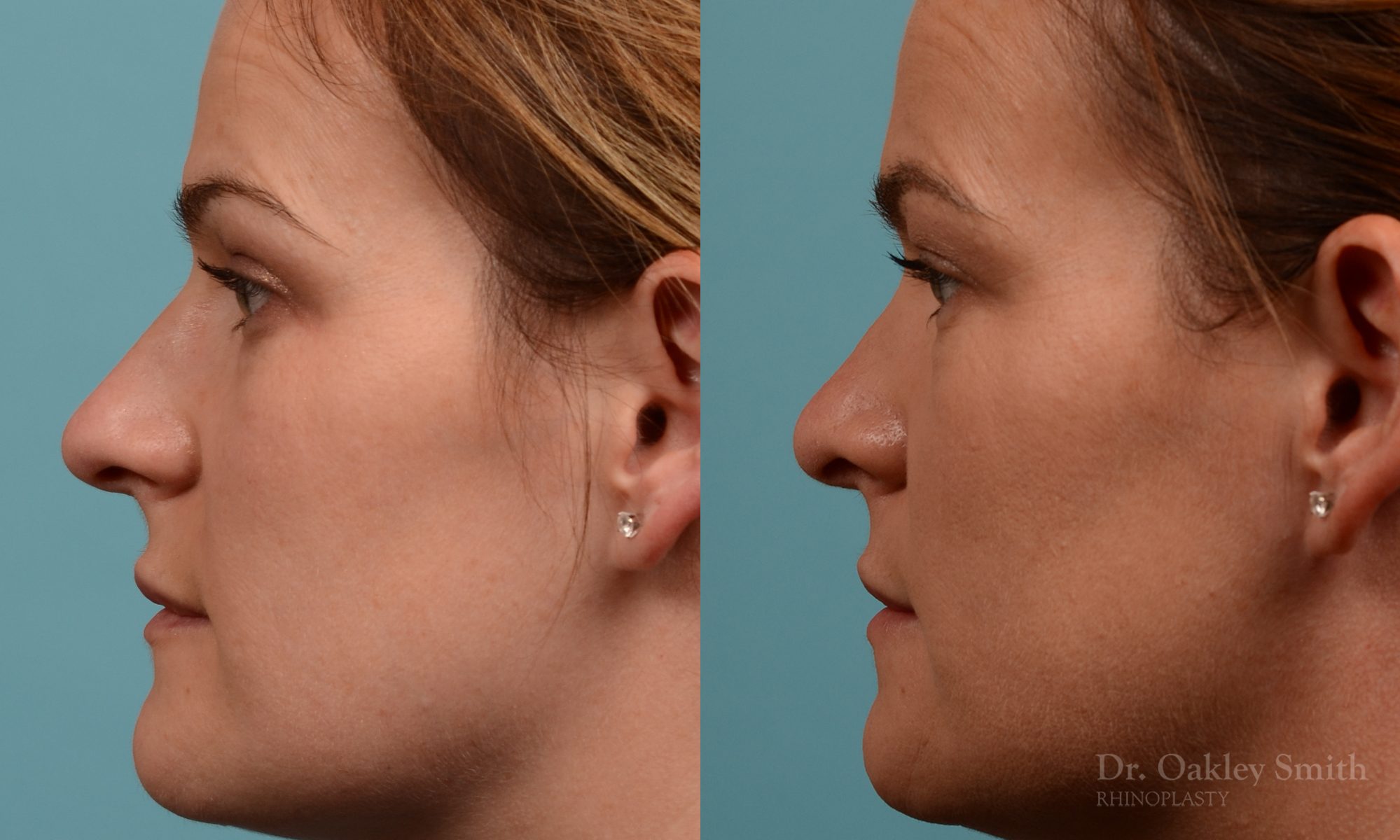 rhinoplasty Nothing demonstrates the skillful craftsmanship that Dr. Oakley Smith accomplishes during his surgeries than a collection of before and after case studies. As one of a hand full of surgeons in North America who limits his practice to only Rhinoplasty surgery, it is obvious that he has mastered his art. There is no question why he is one of the busiest cosmetic nose job surgeons in the country.