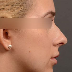 rhinoplasty Nothing demonstrates the skillful craftsmanship that Dr. Oakley Smith accomplishes during his surgeries than a collection of before and after case studies. As one of a hand full of surgeons in North America who limits his practice to only Rhinoplasty surgery, it is obvious that he has mastered his art. There is no question why he is one of the busiest cosmetic nose job surgeons in the country.