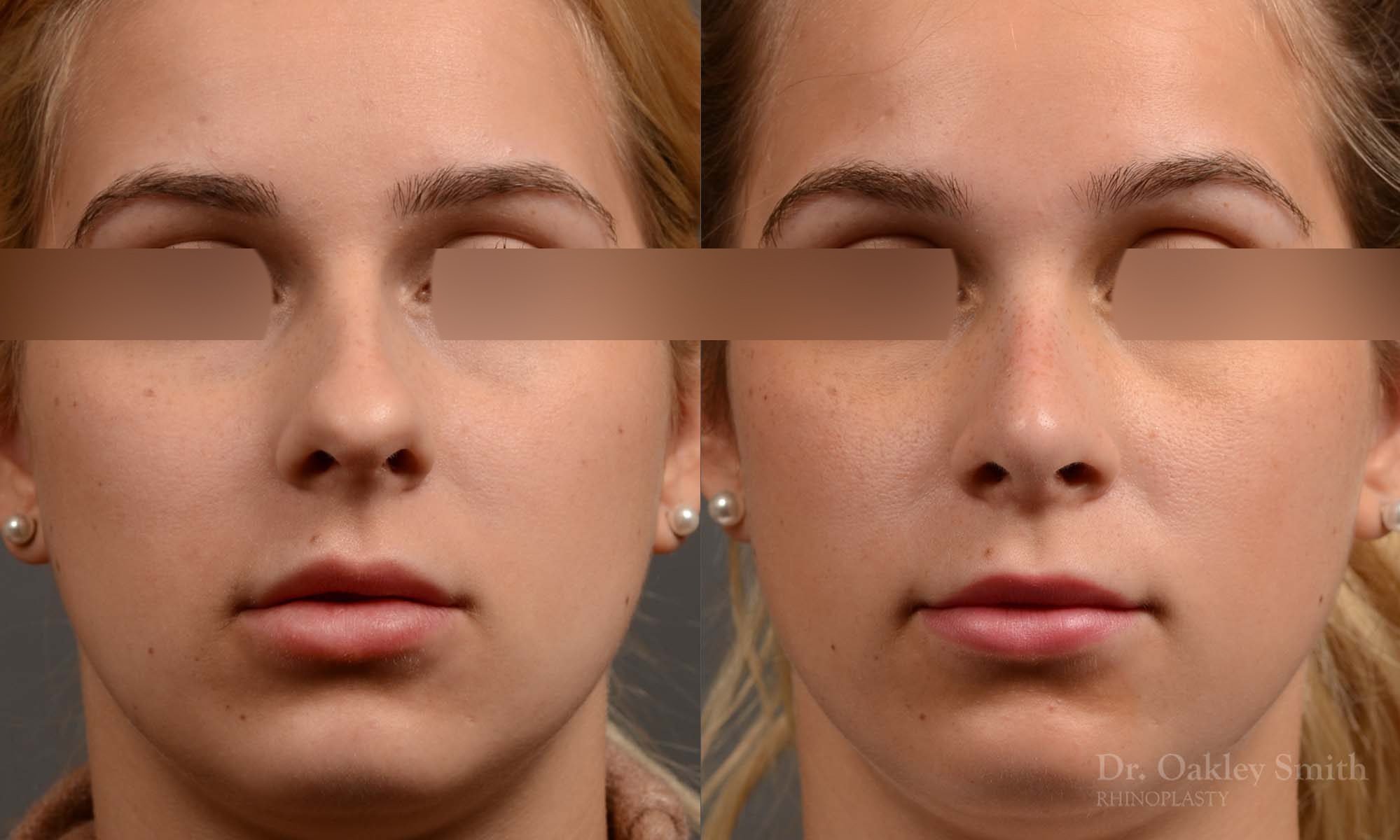 374 rhinoplasty, this woman had revision rhinoplasty to reduce the overall size of her nose.