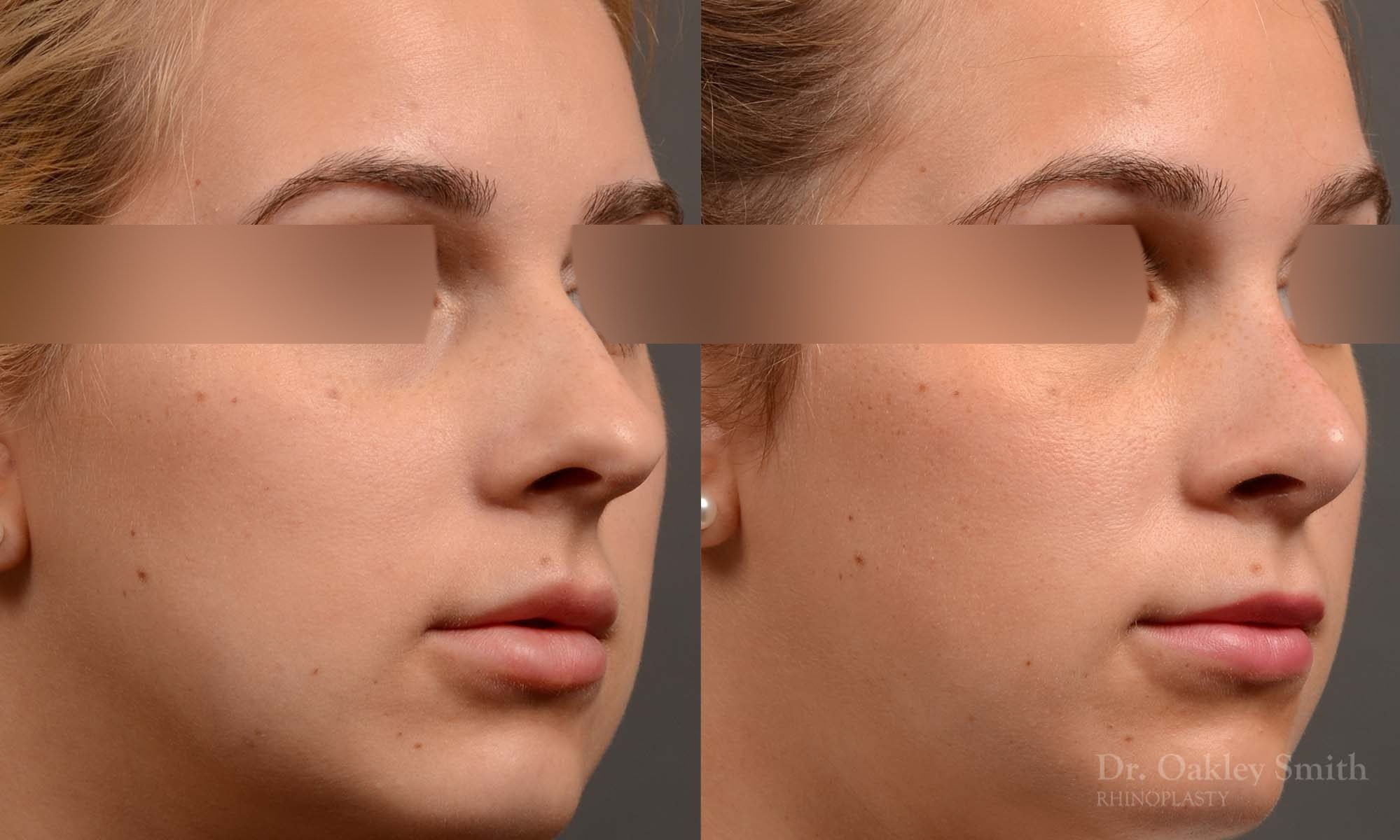 374 rhinoplasty, this woman had revision rhinoplasty to reduce the overall size of her nose.