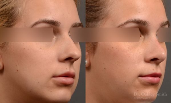 374 rhinoplasty, this woman had revision rhinoplasty to reduce the overall size of her nose.