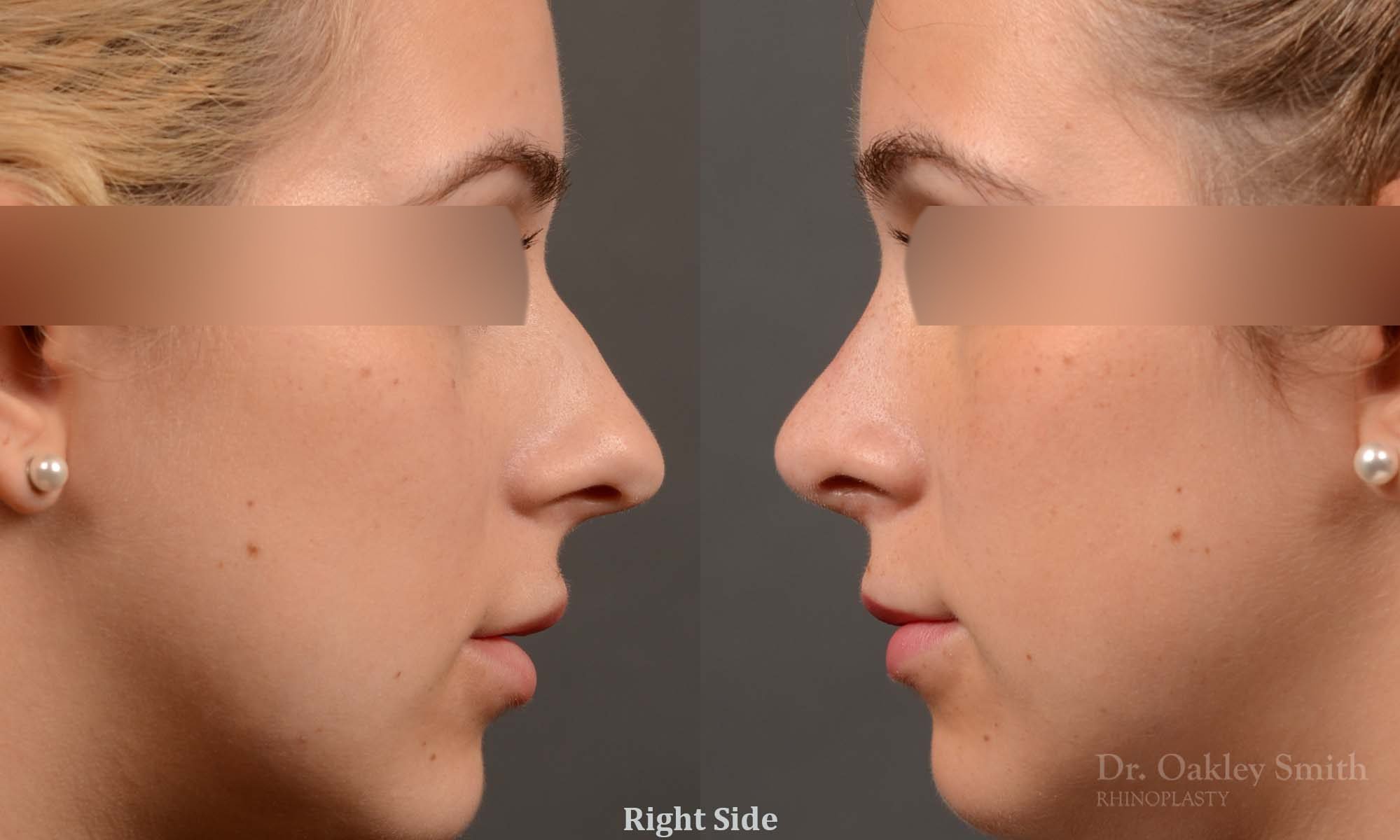 374 rhinoplasty, this woman had revision rhinoplasty to reduce the overall size of her nose.