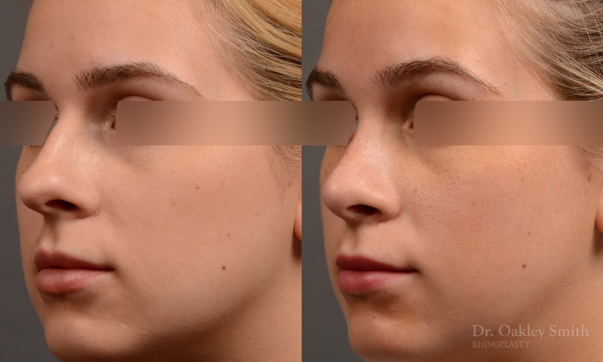 374 rhinoplasty, this woman had revision rhinoplasty to reduce the overall size of her nose.