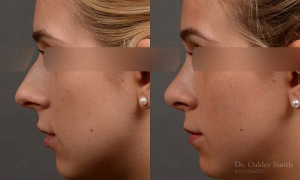 374 rhinoplasty, this woman had revision rhinoplasty to reduce the overall size of her nose.