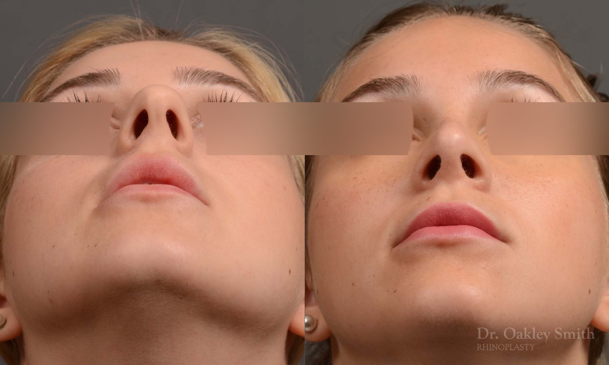 374 rhinoplasty, this woman had revision rhinoplasty to reduce the overall size of her nose.