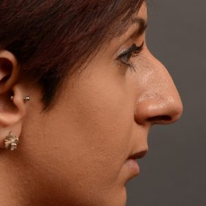 rhinoplasty Nothing demonstrates the skillful craftsmanship that Dr. Oakley Smith accomplishes during his surgeries than a collection of before and after case studies. As one of a hand full of surgeons in North America who limits his practice to only Rhinoplasty surgery, it is obvious that he has mastered his art. There is no question why he is one of the busiest cosmetic nose job surgeons in the country.