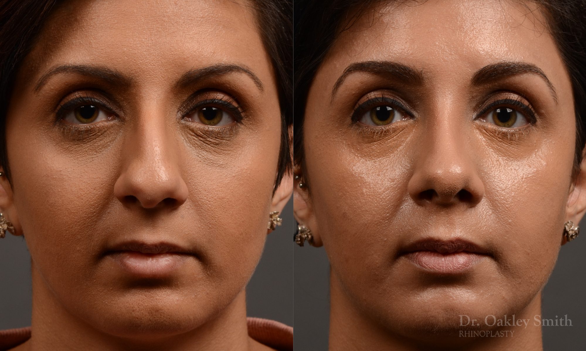 rhinoplasty Nothing demonstrates the skillful craftsmanship that Dr. Oakley Smith accomplishes during his surgeries than a collection of before and after case studies. As one of a hand full of surgeons in North America who limits his practice to only Rhinoplasty surgery, it is obvious that he has mastered his art. There is no question why he is one of the busiest cosmetic nose job surgeons in the country.