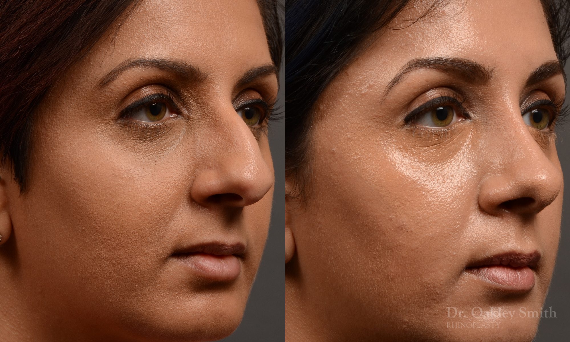 rhinoplasty Nothing demonstrates the skillful craftsmanship that Dr. Oakley Smith accomplishes during his surgeries than a collection of before and after case studies. As one of a hand full of surgeons in North America who limits his practice to only Rhinoplasty surgery, it is obvious that he has mastered his art. There is no question why he is one of the busiest cosmetic nose job surgeons in the country.