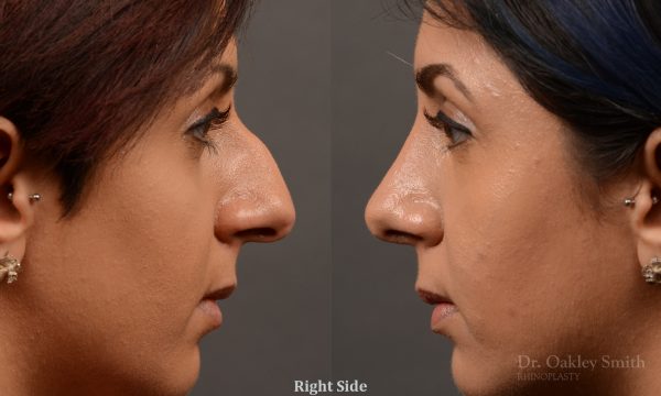 rhinoplasty Nothing demonstrates the skillful craftsmanship that Dr. Oakley Smith accomplishes during his surgeries than a collection of before and after case studies. As one of a hand full of surgeons in North America who limits his practice to only Rhinoplasty surgery, it is obvious that he has mastered his art. There is no question why he is one of the busiest cosmetic nose job surgeons in the country.