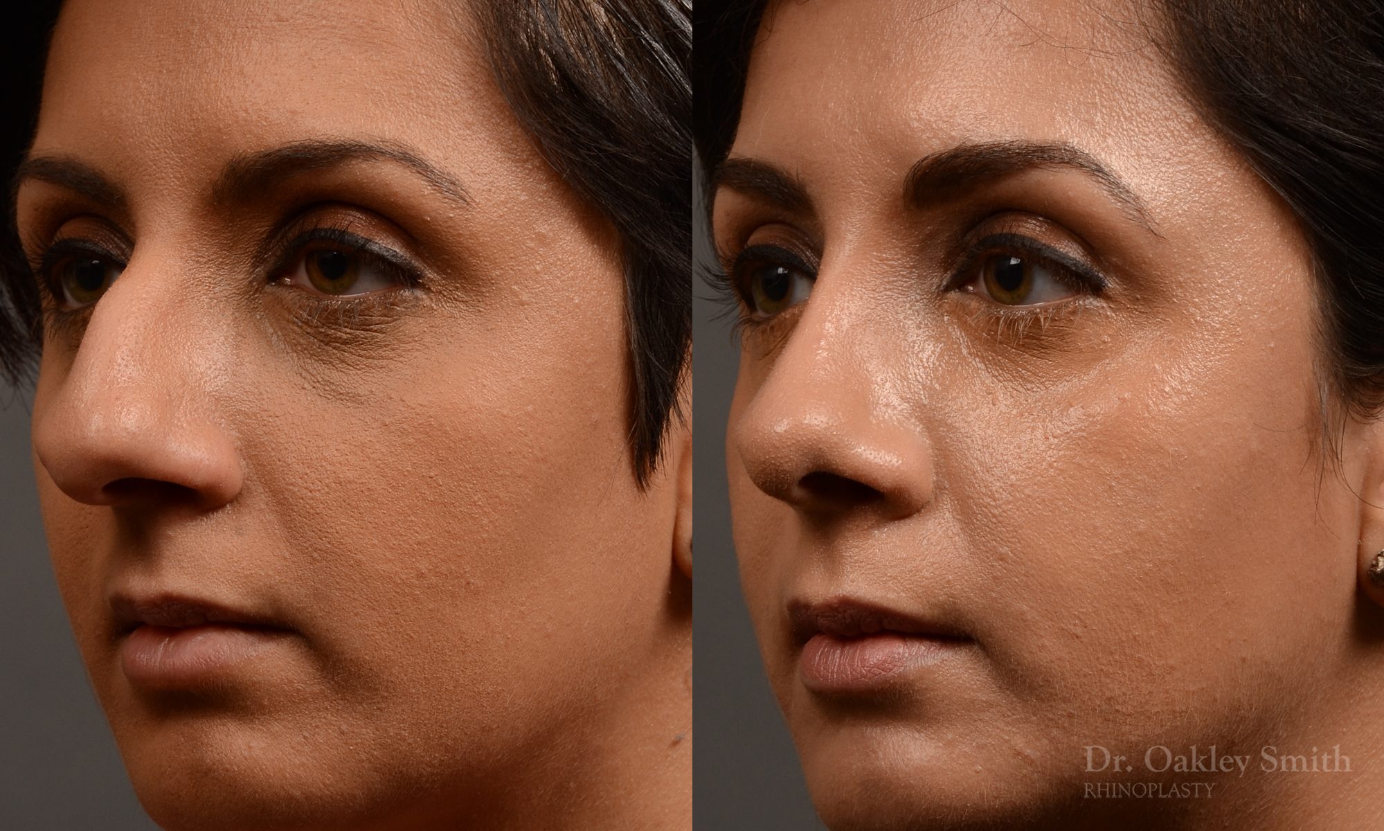 rhinoplasty Nothing demonstrates the skillful craftsmanship that Dr. Oakley Smith accomplishes during his surgeries than a collection of before and after case studies. As one of a hand full of surgeons in North America who limits his practice to only Rhinoplasty surgery, it is obvious that he has mastered his art. There is no question why he is one of the busiest cosmetic nose job surgeons in the country.