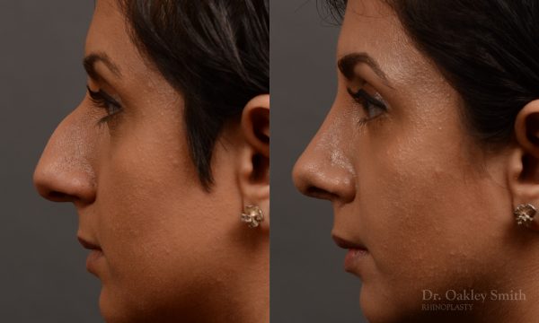 rhinoplasty Nothing demonstrates the skillful craftsmanship that Dr. Oakley Smith accomplishes during his surgeries than a collection of before and after case studies. As one of a hand full of surgeons in North America who limits his practice to only Rhinoplasty surgery, it is obvious that he has mastered his art. There is no question why he is one of the busiest cosmetic nose job surgeons in the country.