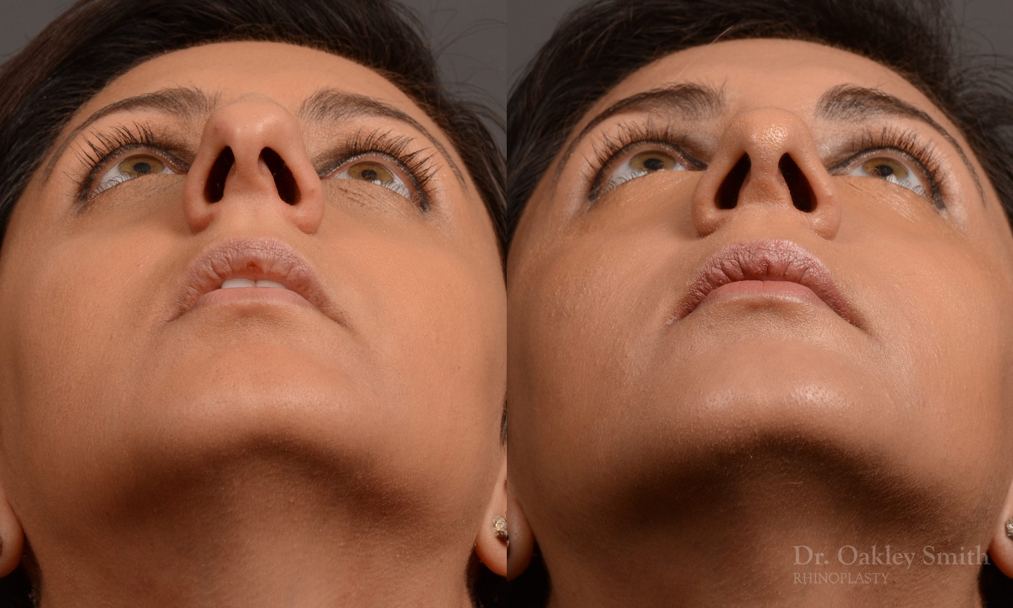 rhinoplasty Nothing demonstrates the skillful craftsmanship that Dr. Oakley Smith accomplishes during his surgeries than a collection of before and after case studies. As one of a hand full of surgeons in North America who limits his practice to only Rhinoplasty surgery, it is obvious that he has mastered his art. There is no question why he is one of the busiest cosmetic nose job surgeons in the country.