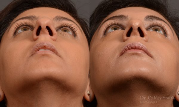 rhinoplasty Nothing demonstrates the skillful craftsmanship that Dr. Oakley Smith accomplishes during his surgeries than a collection of before and after case studies. As one of a hand full of surgeons in North America who limits his practice to only Rhinoplasty surgery, it is obvious that he has mastered his art. There is no question why he is one of the busiest cosmetic nose job surgeons in the country.