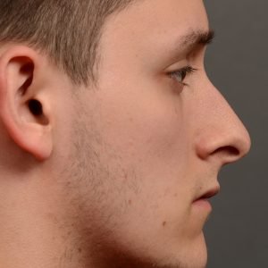 rhinoplasty Nothing demonstrates the skillful craftsmanship that Dr. Oakley Smith accomplishes during his surgeries than a collection of before and after case studies. As one of a hand full of surgeons in North America who limits his practice to only Rhinoplasty surgery, it is obvious that he has mastered his art. There is no question why he is one of the busiest cosmetic nose job surgeons in the country.