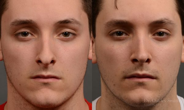 rhinoplasty Nothing demonstrates the skillful craftsmanship that Dr. Oakley Smith accomplishes during his surgeries than a collection of before and after case studies. As one of a hand full of surgeons in North America who limits his practice to only Rhinoplasty surgery, it is obvious that he has mastered his art. There is no question why he is one of the busiest cosmetic nose job surgeons in the country.