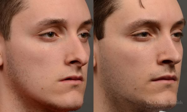 rhinoplasty Nothing demonstrates the skillful craftsmanship that Dr. Oakley Smith accomplishes during his surgeries than a collection of before and after case studies. As one of a hand full of surgeons in North America who limits his practice to only Rhinoplasty surgery, it is obvious that he has mastered his art. There is no question why he is one of the busiest cosmetic nose job surgeons in the country.