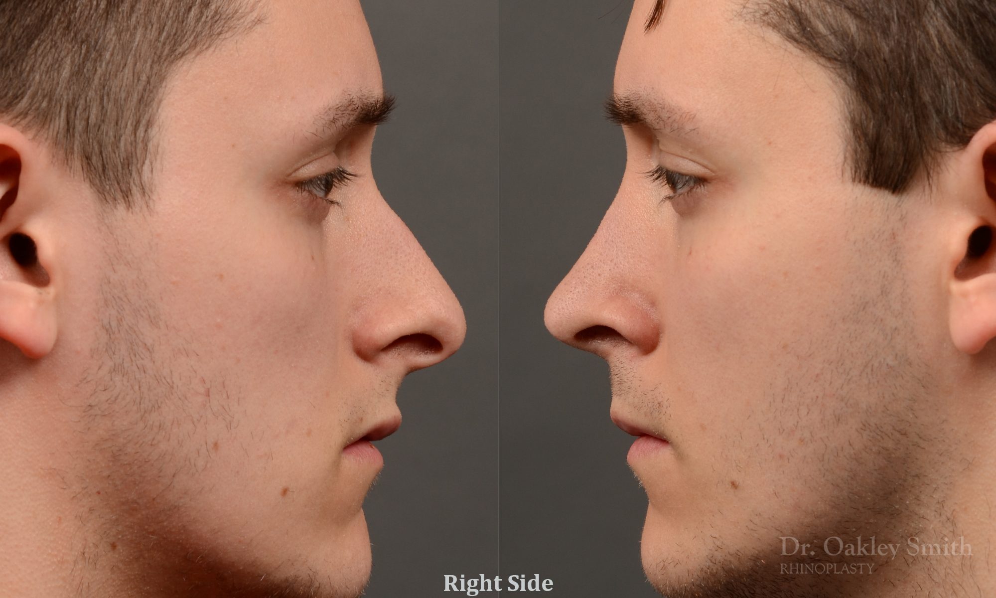 rhinoplasty Nothing demonstrates the skillful craftsmanship that Dr. Oakley Smith accomplishes during his surgeries than a collection of before and after case studies. As one of a hand full of surgeons in North America who limits his practice to only Rhinoplasty surgery, it is obvious that he has mastered his art. There is no question why he is one of the busiest cosmetic nose job surgeons in the country.