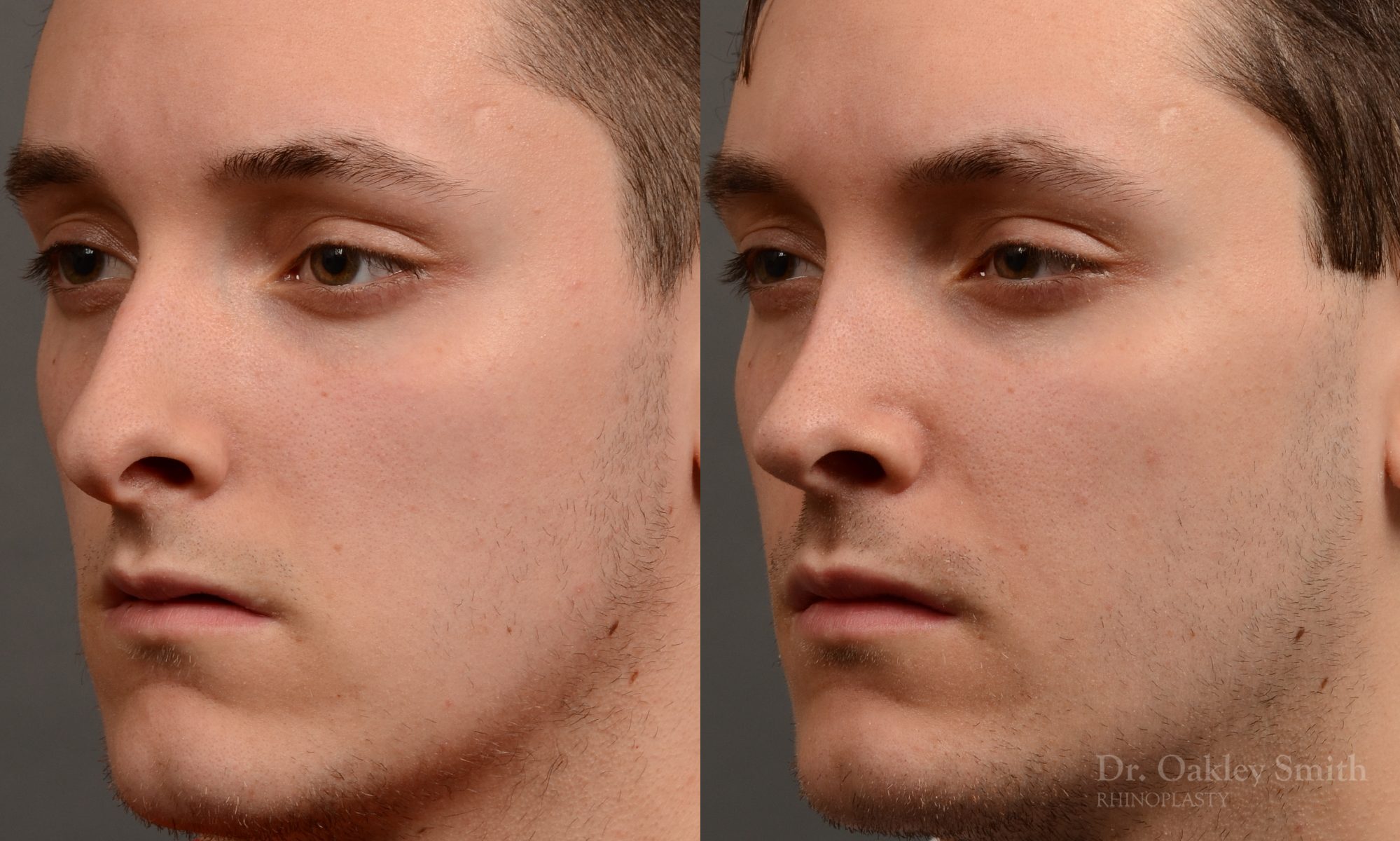 rhinoplasty Nothing demonstrates the skillful craftsmanship that Dr. Oakley Smith accomplishes during his surgeries than a collection of before and after case studies. As one of a hand full of surgeons in North America who limits his practice to only Rhinoplasty surgery, it is obvious that he has mastered his art. There is no question why he is one of the busiest cosmetic nose job surgeons in the country.