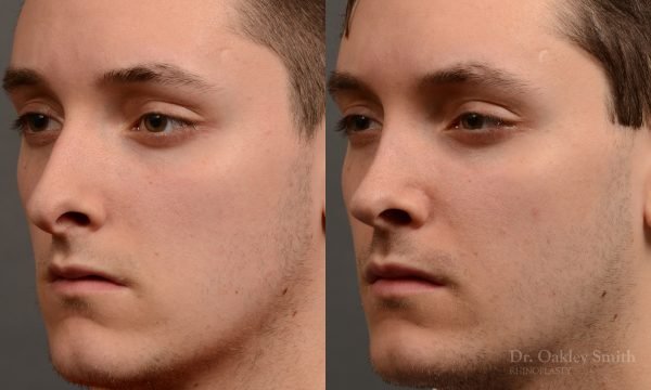 rhinoplasty Nothing demonstrates the skillful craftsmanship that Dr. Oakley Smith accomplishes during his surgeries than a collection of before and after case studies. As one of a hand full of surgeons in North America who limits his practice to only Rhinoplasty surgery, it is obvious that he has mastered his art. There is no question why he is one of the busiest cosmetic nose job surgeons in the country.
