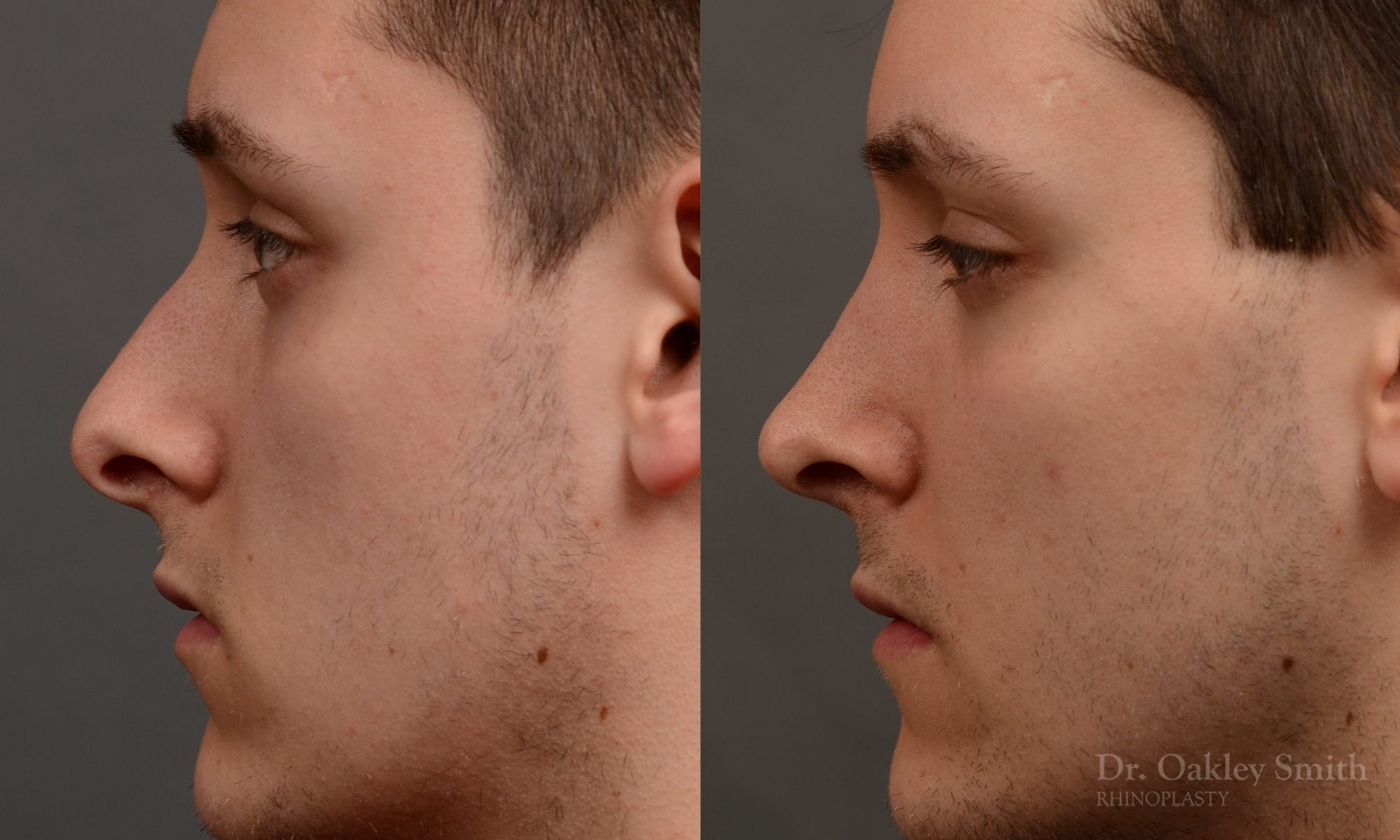 rhinoplasty Nothing demonstrates the skillful craftsmanship that Dr. Oakley Smith accomplishes during his surgeries than a collection of before and after case studies. As one of a hand full of surgeons in North America who limits his practice to only Rhinoplasty surgery, it is obvious that he has mastered his art. There is no question why he is one of the busiest cosmetic nose job surgeons in the country.