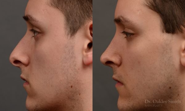 rhinoplasty Nothing demonstrates the skillful craftsmanship that Dr. Oakley Smith accomplishes during his surgeries than a collection of before and after case studies. As one of a hand full of surgeons in North America who limits his practice to only Rhinoplasty surgery, it is obvious that he has mastered his art. There is no question why he is one of the busiest cosmetic nose job surgeons in the country.