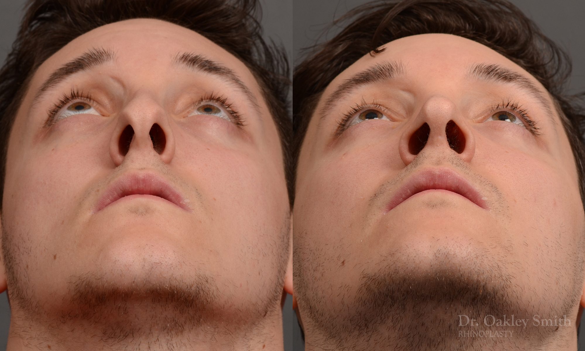 rhinoplasty Nothing demonstrates the skillful craftsmanship that Dr. Oakley Smith accomplishes during his surgeries than a collection of before and after case studies. As one of a hand full of surgeons in North America who limits his practice to only Rhinoplasty surgery, it is obvious that he has mastered his art. There is no question why he is one of the busiest cosmetic nose job surgeons in the country.