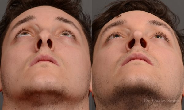 rhinoplasty Nothing demonstrates the skillful craftsmanship that Dr. Oakley Smith accomplishes during his surgeries than a collection of before and after case studies. As one of a hand full of surgeons in North America who limits his practice to only Rhinoplasty surgery, it is obvious that he has mastered his art. There is no question why he is one of the busiest cosmetic nose job surgeons in the country.