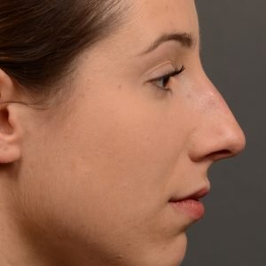 rhinoplasty Nothing demonstrates the skillful craftsmanship that Dr. Oakley Smith accomplishes during his surgeries than a collection of before and after case studies. As one of a hand full of surgeons in North America who limits his practice to only Rhinoplasty surgery, it is obvious that he has mastered his art. There is no question why he is one of the busiest cosmetic nose job surgeons in the country.