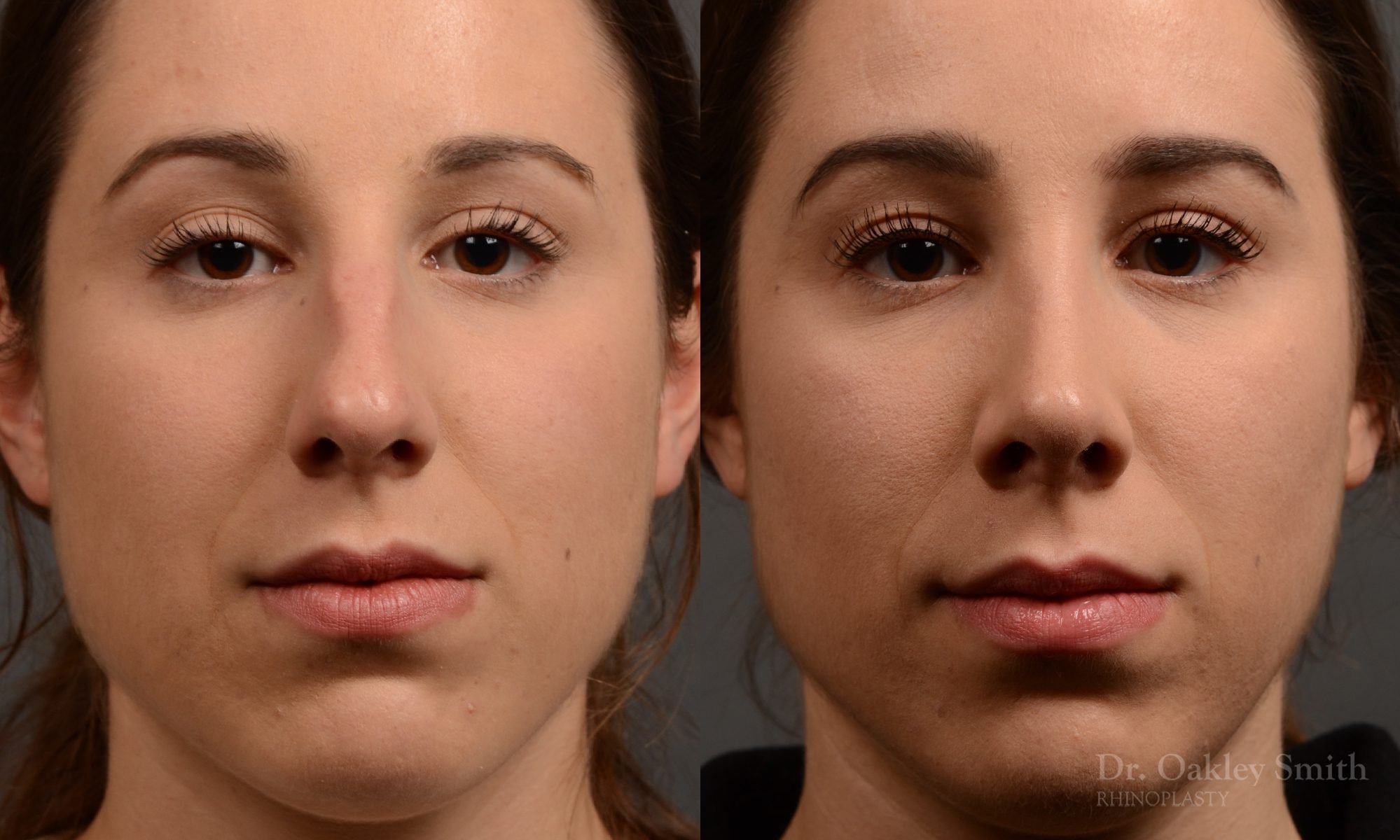 rhinoplasty Nothing demonstrates the skillful craftsmanship that Dr. Oakley Smith accomplishes during his surgeries than a collection of before and after case studies. As one of a hand full of surgeons in North America who limits his practice to only Rhinoplasty surgery, it is obvious that he has mastered his art. There is no question why he is one of the busiest cosmetic nose job surgeons in the country.