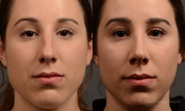 rhinoplasty Nothing demonstrates the skillful craftsmanship that Dr. Oakley Smith accomplishes during his surgeries than a collection of before and after case studies. As one of a hand full of surgeons in North America who limits his practice to only Rhinoplasty surgery, it is obvious that he has mastered his art. There is no question why he is one of the busiest cosmetic nose job surgeons in the country.